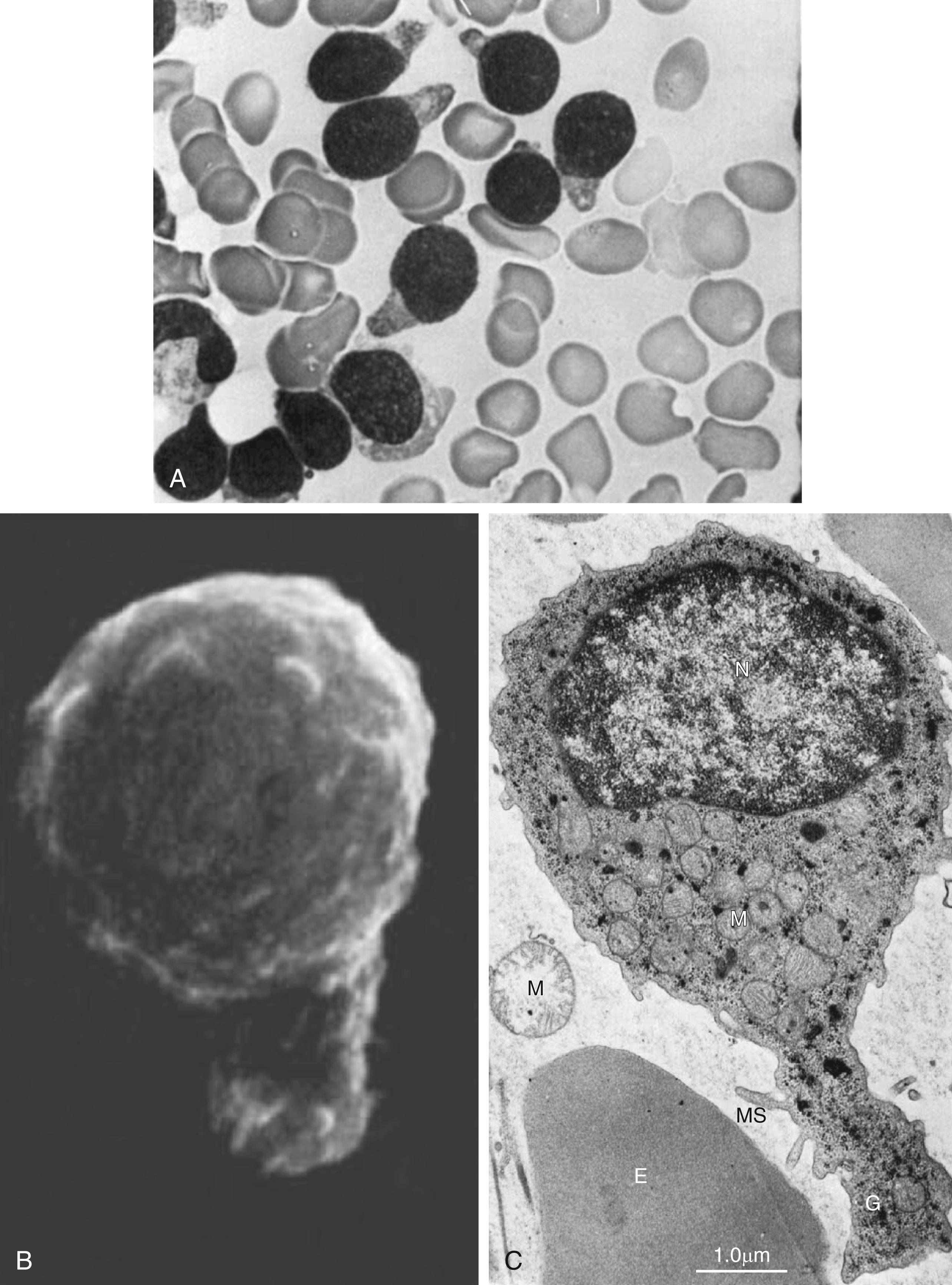 Fig. 9.6, Acute lymphoblastic leukemia: hand mirror cell variant. (A) Bone marrow smear showing blasts, with scant cytoplasm, cytoplasmic tail projections, hand mirror cell, fine chromatin, and indistinct nucleoli. (B) Scanning electron micrograph showing blast with uropod extension and microspikes. (C) Electron micrography of hand mirror cell. E, erythrocte; G, glycogen; M, mitochondria; MS, microspikes; N, nucleus.