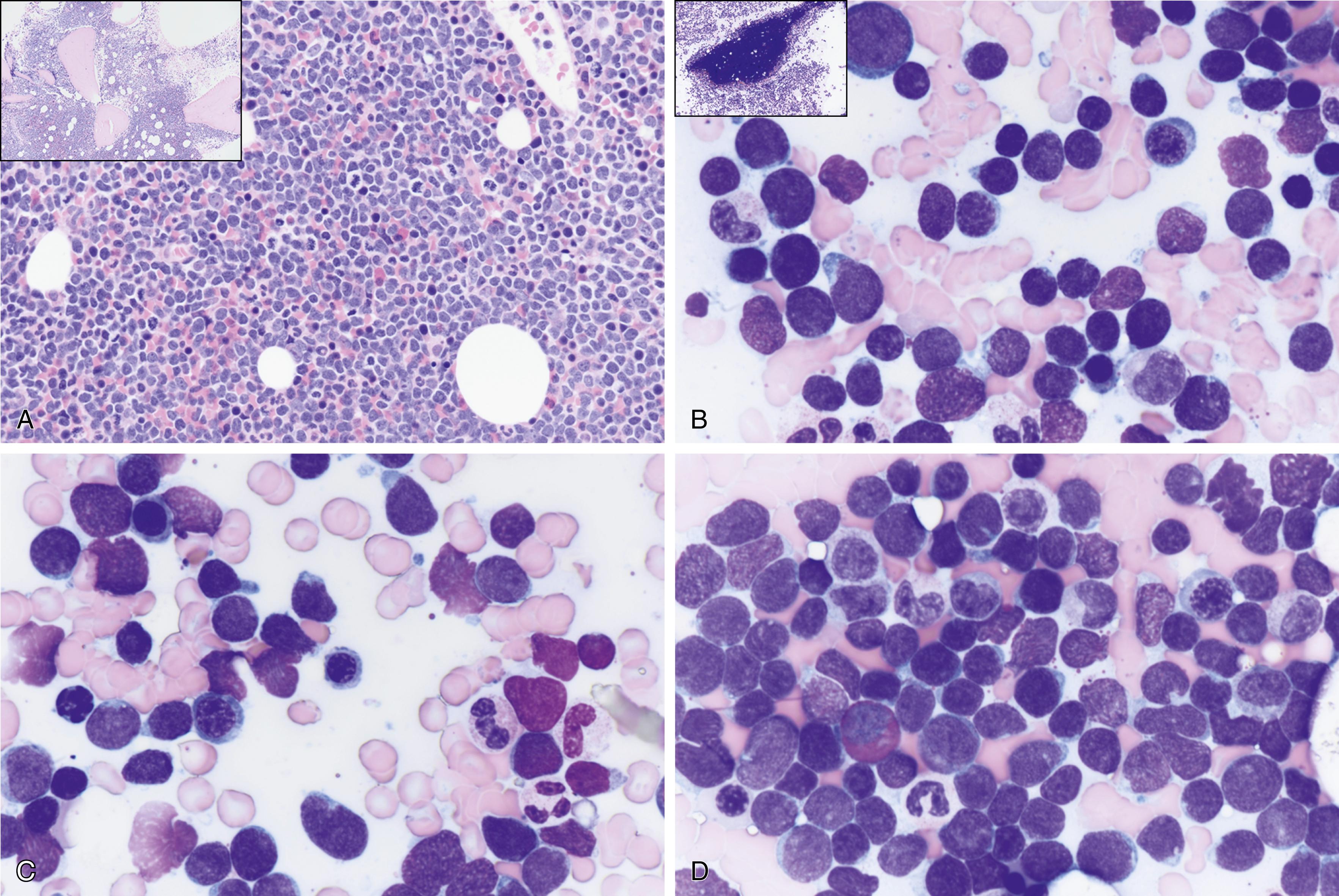 Fig. 9.7, (A) T-cell acute lymphoblastic leukemia/lymphoma (ALL) is morphologically indistinguishable from B-cell ALL. Both types show hypercellular marrow cellularity by monomorphic blue cell proliferation, infiltration 15% incidence compared with 85% for B-cell ALL. The inset shows a low-power view of bone marrow biopsy. (B) T-cell acute ALL is morphologically indistinguishable from B-cell ALL. Both types show hypercellular marrow cellularity by monomorphic blue cell proliferation with infiltration. Both types can show a bimorphic blast cell population; small- to medium- and large-sized blasts; fine chromatin, indistinct nucleoli, podlike projections; hand mirror sign; and scanty cytoplasm. The inset shows a low-power view of bone marrow aspirate spicule. (C) T-cell ALL is morphologically indistinguishable from B-cell ALL. Some cells have nuclear notching, indentation, grooves, and atypical mitotic figures. (D) T-cell ALL is morphologically indistinguishable from B-cell ALL. Both can show eosinophilia.