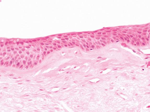 FIG. 30.2, Squamous metaplasia. Although most of the epithelial cells have squamous characteristics, occasional residual surface columnar cells are seen on the left.