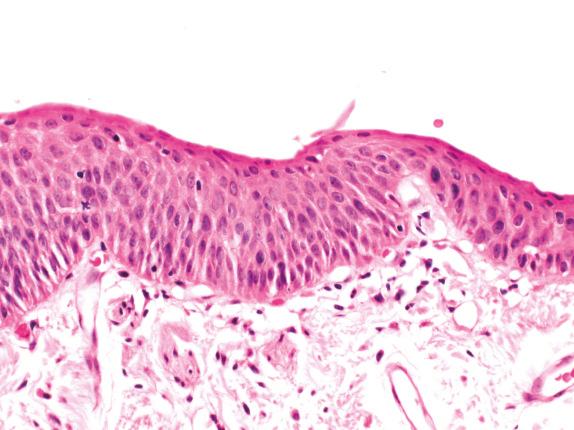 FIG. 30.3, Mild dysplasia. Mild dysplasia demonstrates mild atypia involving only the lower third of the squamous epithelium.