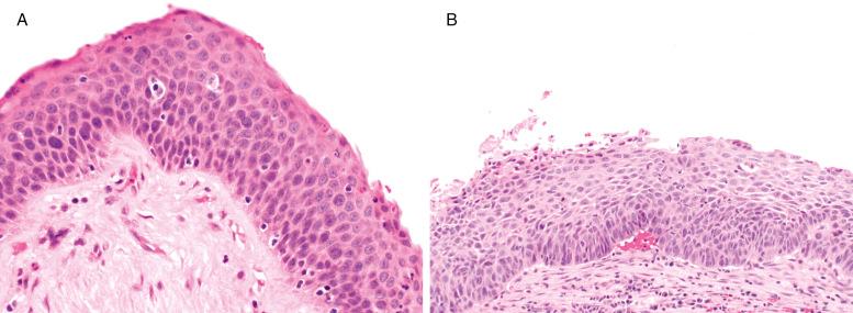 FIG. 30.4, Moderate dysplasia. Notable cytologic atypia extends upward to involve the middle third of the epithelium, sufficient for moderate dysplasia even in the absence of mitoses (A). Although the extent of the basaloid zone seems less, a mitotic figure is present well off the base of the epithelium (B).