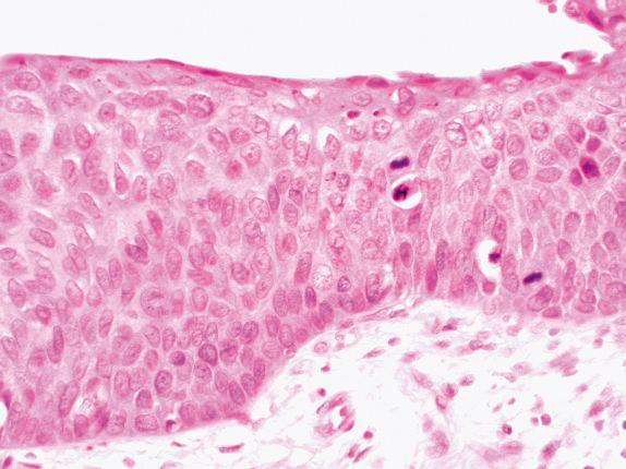 FIG. 30.5, Severe dysplasia. Enlarged atypical cells are present at all levels with minimal surface maturation. Mitotic figures lie in the lower and middle thirds of the epithelium.