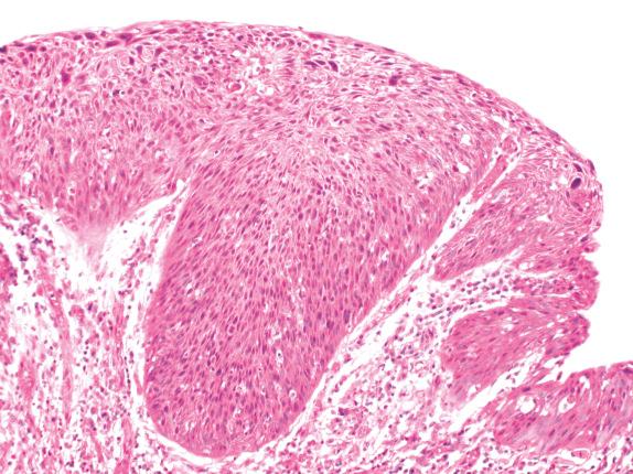 FIG. 30.6, Squamous cell carcinoma in situ. Severe pleomorphism at all levels and a lack of maturation or organization in the epithelium characterize squamous cell carcinoma in situ. In this example, the epithelium is also very thick.