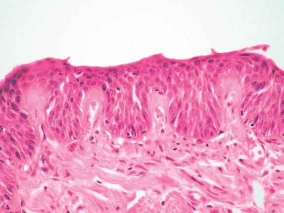 FIG. 30.7, Squamous dysplasia, angiogenic. This example of angiogenic squamous dysplasia shows cytologic atypia, as well as the characteristic vascular sprouts, covered by a thickened basement membrane, protruding upward into the epithelium.