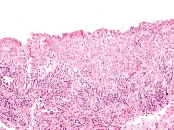 FIG. 30.8, Squamous metaplasia with reactive atypia. This irregular metaplastic squamous epithelium is associated with marked bronchial mucosal inflammation. The mild cytologic atypia is considered reactive. The airway that was biopsied drained a zone of long-standing infection with a lung abscess.