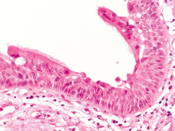 FIG. 30.9, Squamous atypia. Ciliated respiratory epithelial cells lie over a zone of squamous epithelial cells exhibiting significant atypia. If the columnar cells are shed, dysplastic squamous epithelium will be left behind and can be difficult to grade.