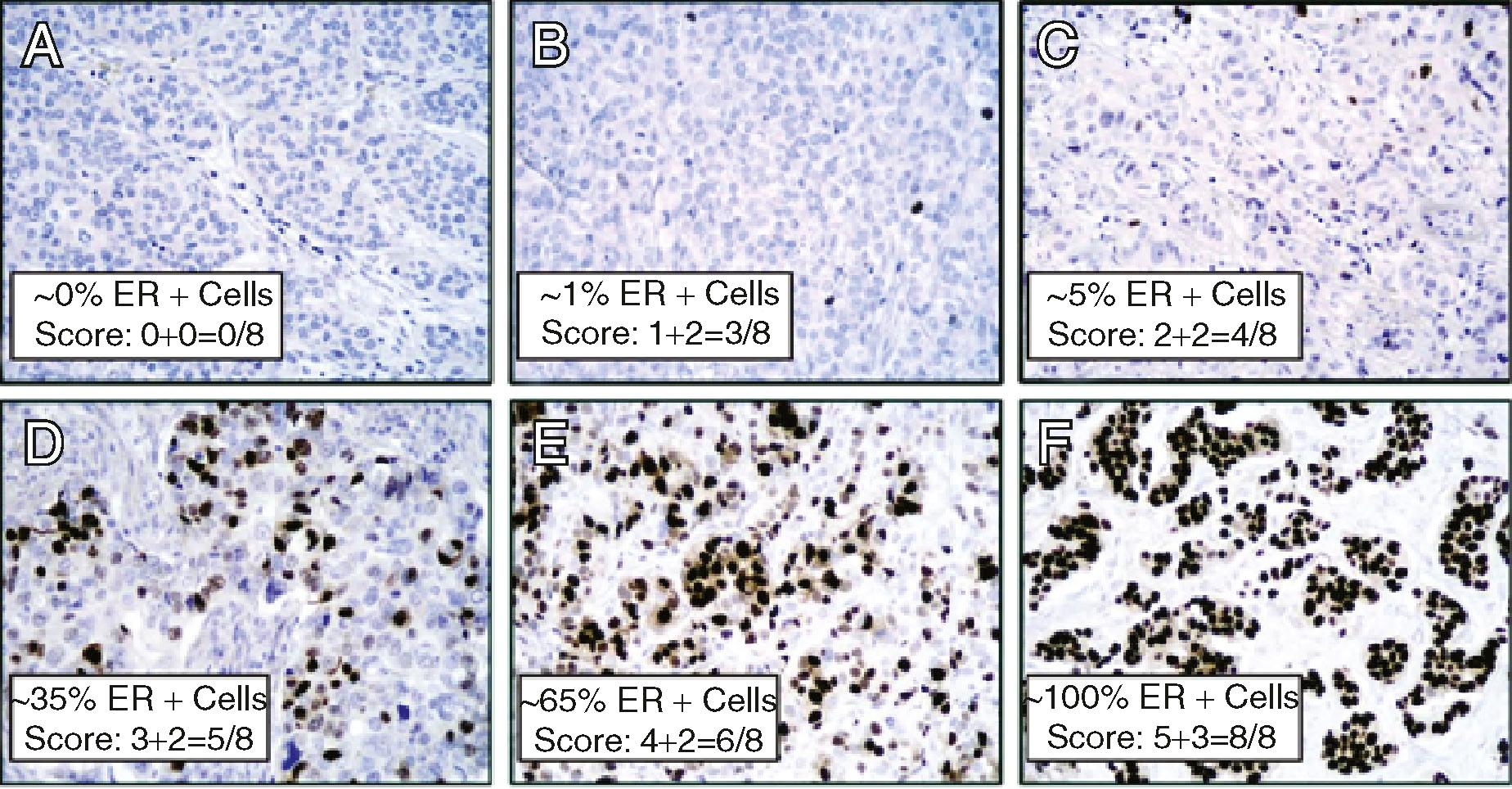 Fig. 9.3, Summary of estrogen receptor (ER) results from a study by Harvey and colleagues. There is a near linear correlation between immunohistochemistry (IHC) and ligand-binding assay (LBA) ER results, a broad distribution of IHC (Allred) scores, a skewed but direct correlation between Allred scores and improved disease-free survival in patients treated with adjuvant hormonal therapy (primarily tamoxifen), and significantly stronger prediction of response to hormonal therapy associated with ER by IHC versus LBA. ( A ) Allred score 0. ( B ) Allred score 3. ( C ) Allred score 4. ( D ) Allred score 5. ( E ) Allred score 6. ( F ) Allred score 8.