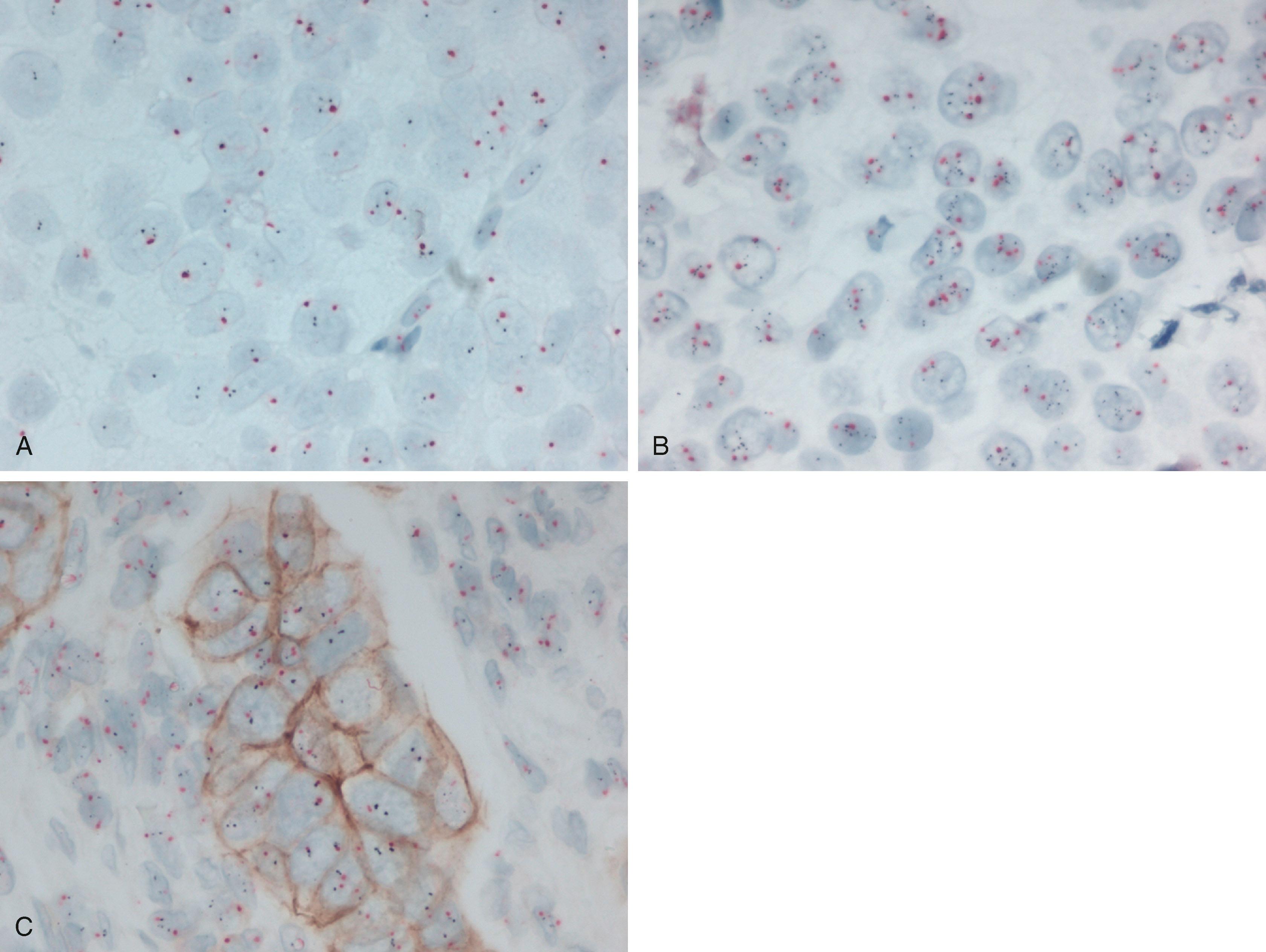 Fig. 9.7, Representative photomicrographs from bright-field in situ hybridization assays. ( A ) A dual in situ hybridization assay (DISH) showing lack of human epidermal growth factor receptor 2 (HER2) gene amplification with approximately 2 signals for both the HER2 gene (black) and chromosome 17 centromere (red) in each cell. ( B ) DISH assay showing an increase in black HER2 gene copies, consistent with HER2 gene amplification. ( C ) HER2 gene protein assay showing moderate membranous reactivity (IHC score of 2+) of tumor cells, but a lack of HER2 gene amplification. Notice the lack of HER2 protein (no brown membranous staining) in stromal cells but normal copies of the HER2 gene. IHC , Immunohistochemistry.