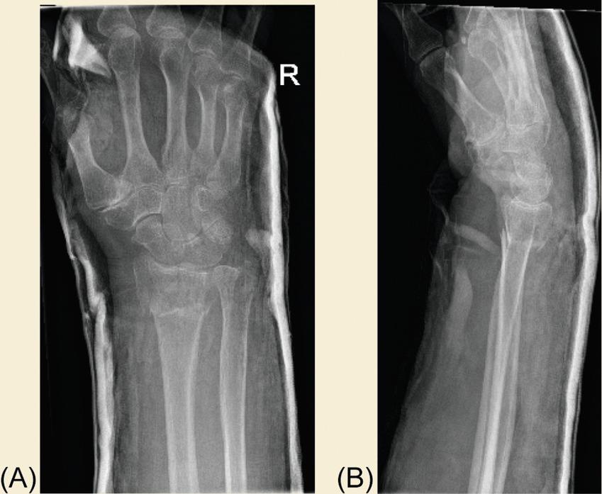 Fig. 2, Immediate postreduction radiographs.