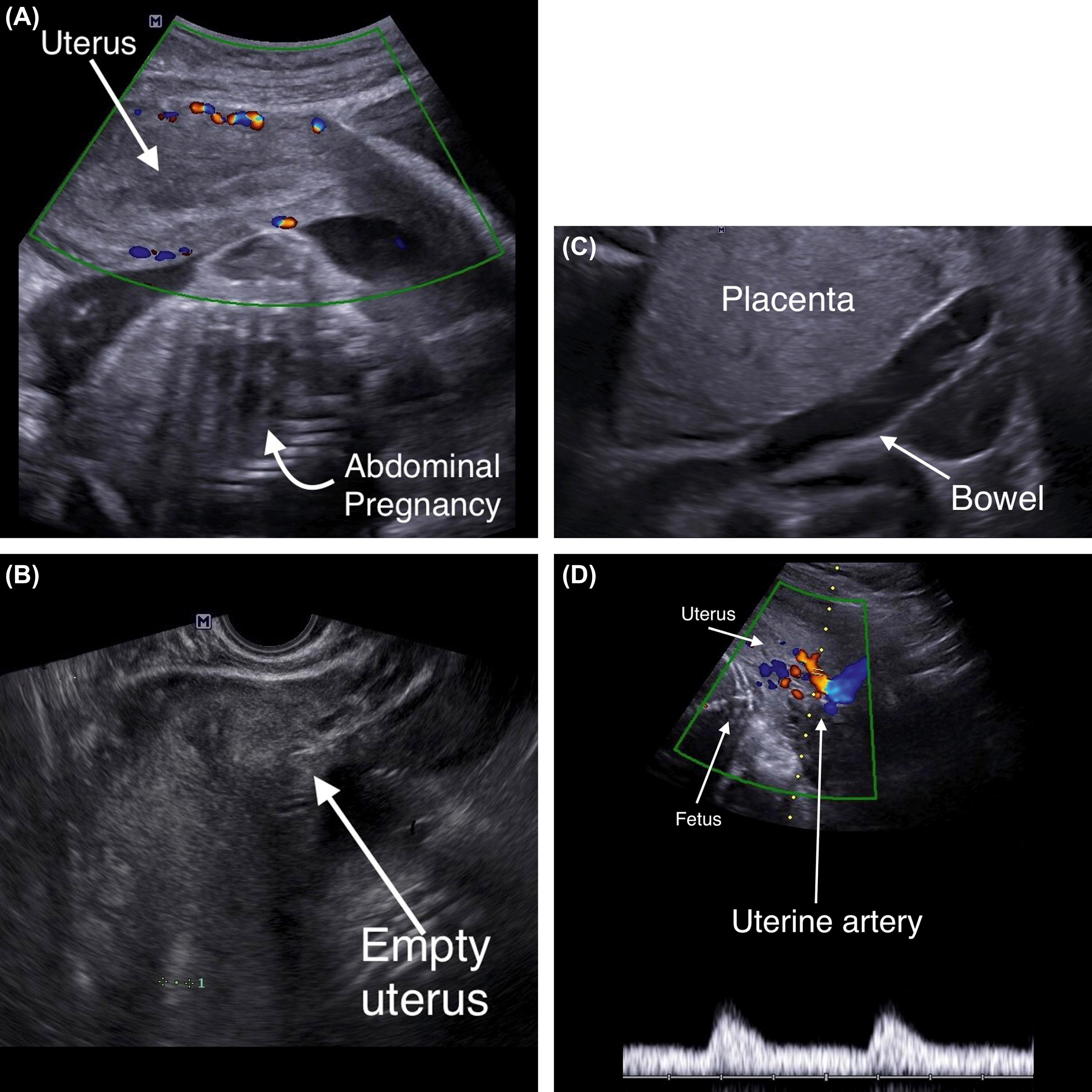 Fig. 29.1, Ultrasound findings in abdominal pregnancy at 27 weeks' gestation. (A) Note the fetus is behind the uterus. (B) Ultrasound of the uterus that is empty. (C) The placenta is implanted above the sigmoid colon. (D) Uterine artery with velocity waveforms; the uterine artery (red color) is directed towards the uterus.