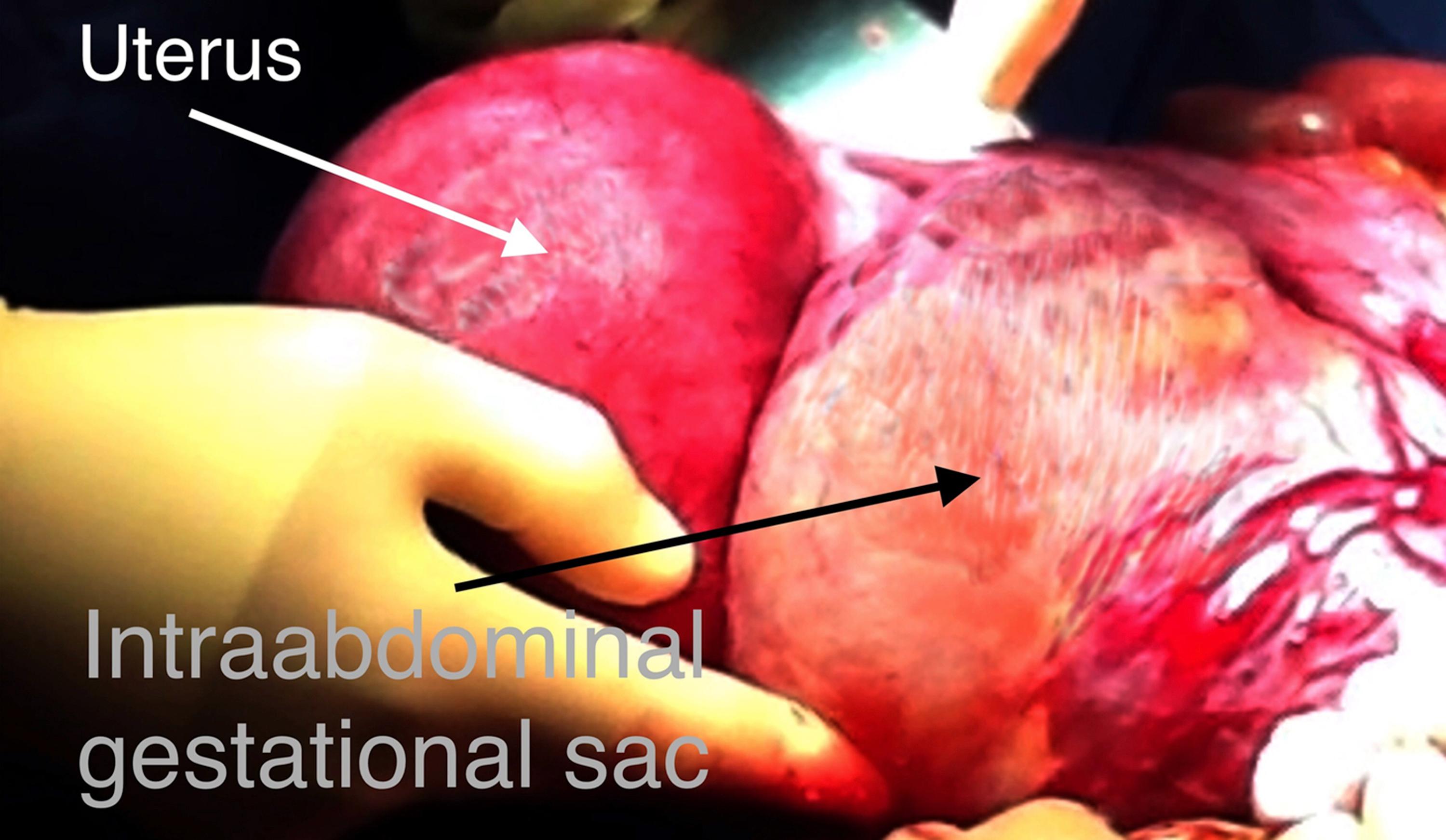 Fig. 29.2, Abdominal pregnancy with gestational sac behind the uterus.