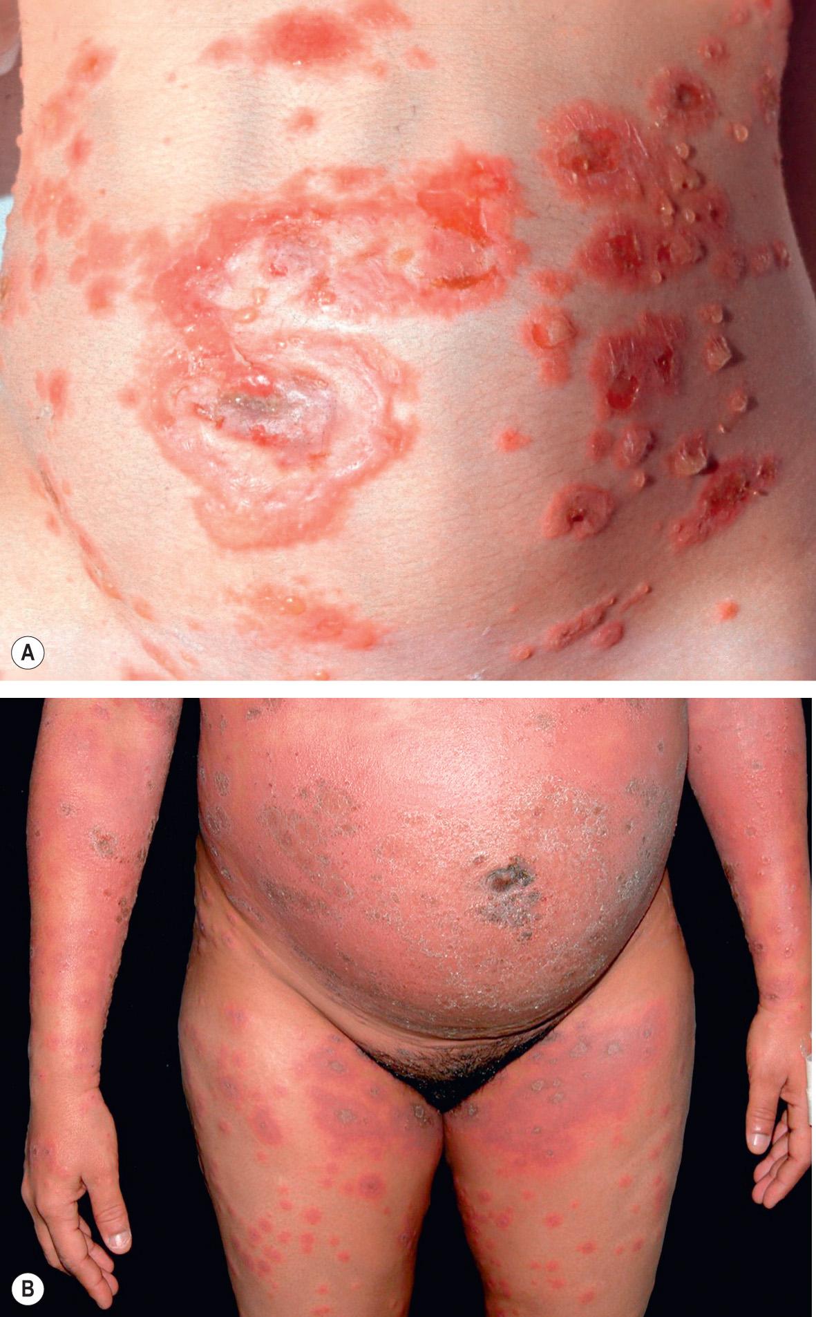 Fig. 27.1, Pemphigoid gestationis.