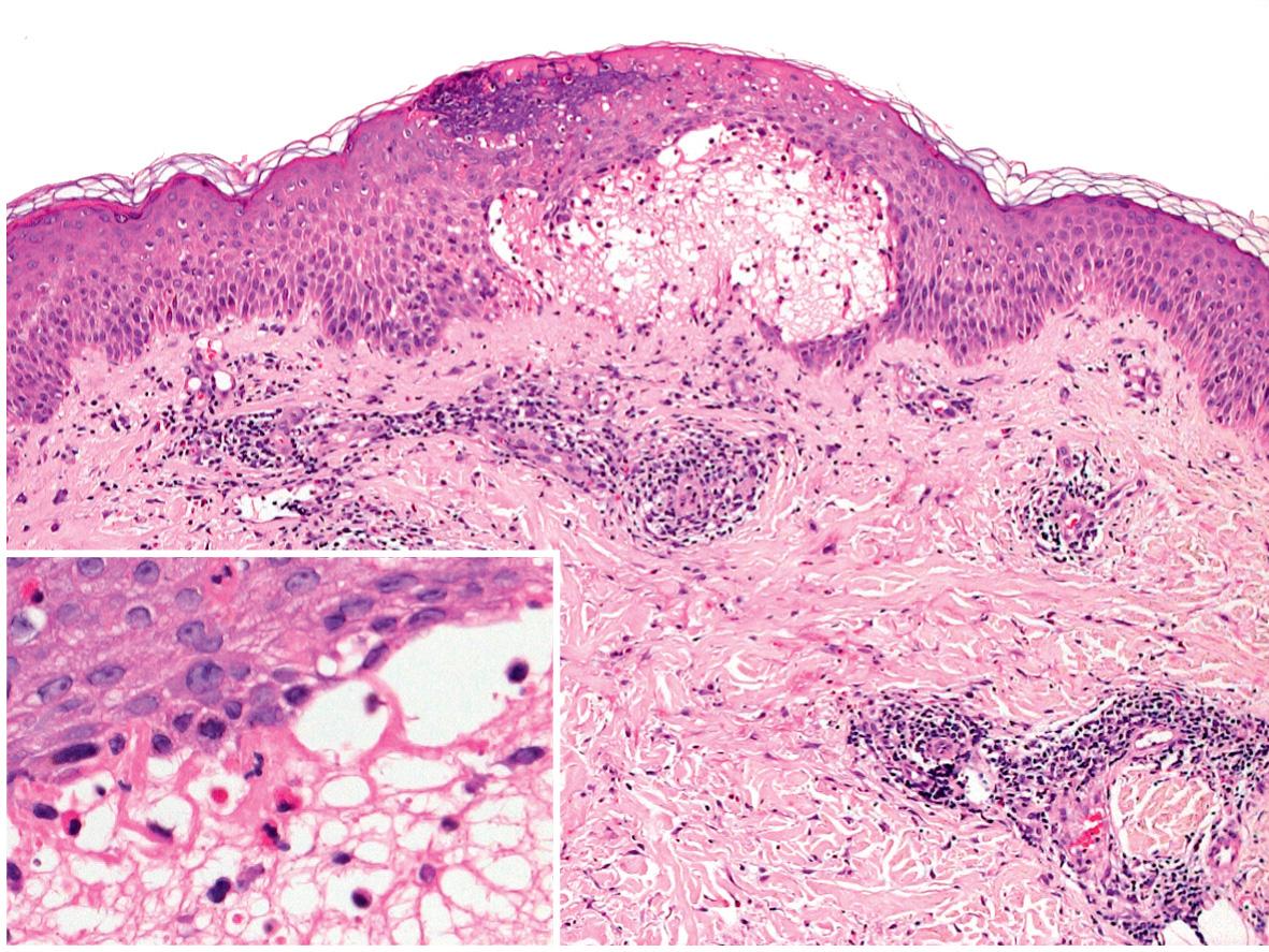 Fig. 27.2, Pemphigoid gestationis – histologic features of an early lesion.