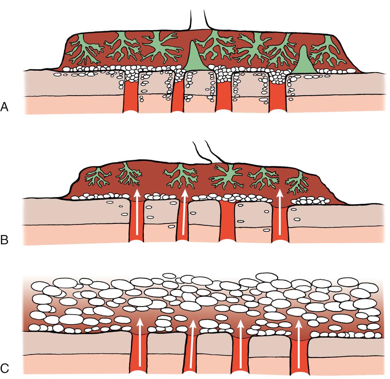 Fig. 33.2, Placentation in a normal ongoing pregnancy (A), in an early pregnancy failure (B), and in a complete hydatidiform mole (C). (A) Note the continuous trophoblastic shell, the plugs in the lumens of the spiral arteries, and the interstitial migration of the extravillous trophoblast through the decidua down to the superficial layer of the myometrium. (B) Note the discontinuous trophoblastic shell, the absence of plugs, and the reduced migration of extravillous trophoblastic cells. (C) Note the absence of trophoblastic plugs and interstitial migration.