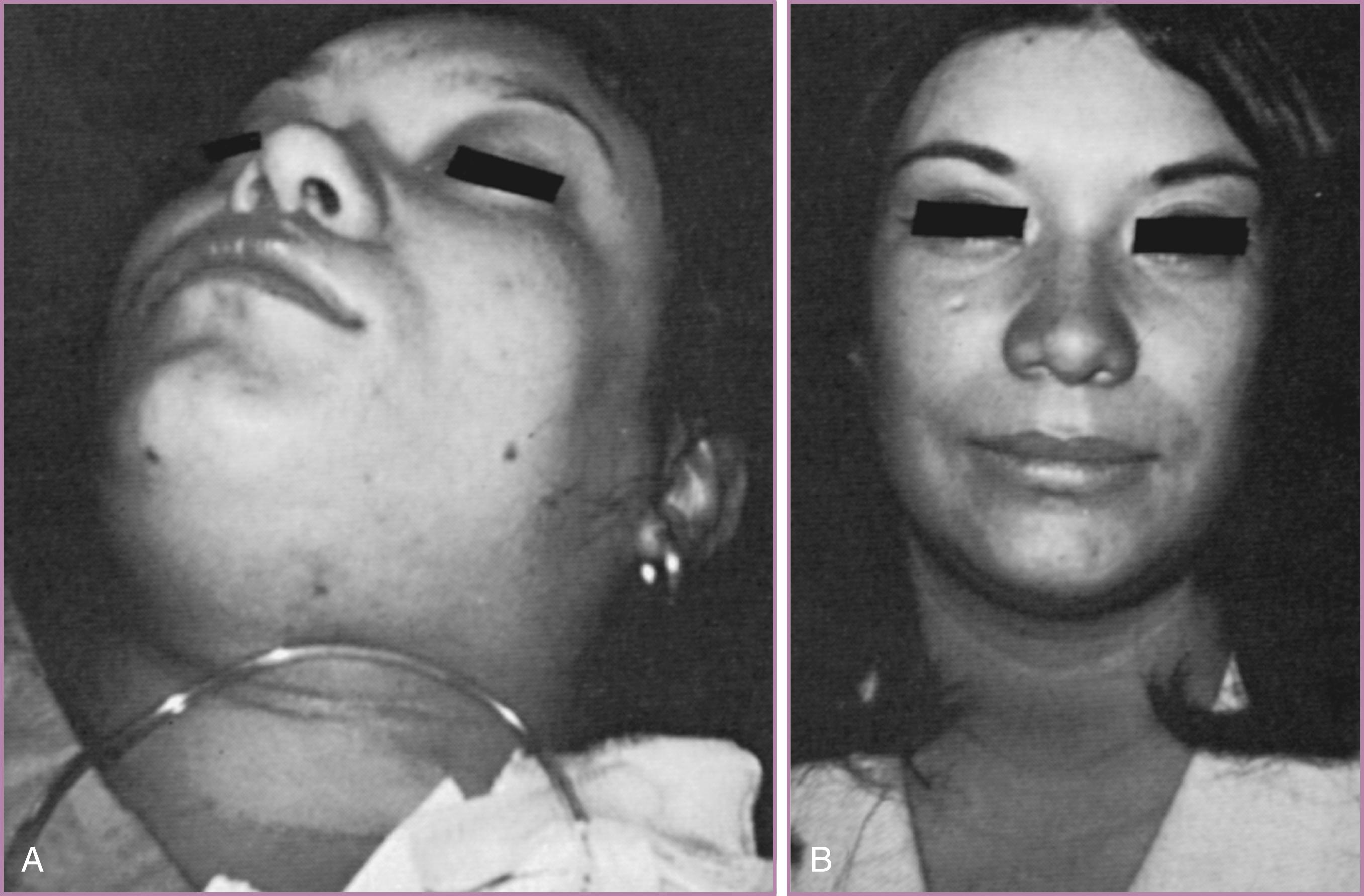 Figure 45.1, Facial edema in severe preeclampsia.