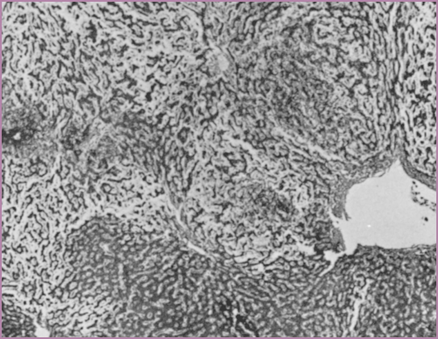 Figure 45.5, Hepatic infarction in eclampsia.