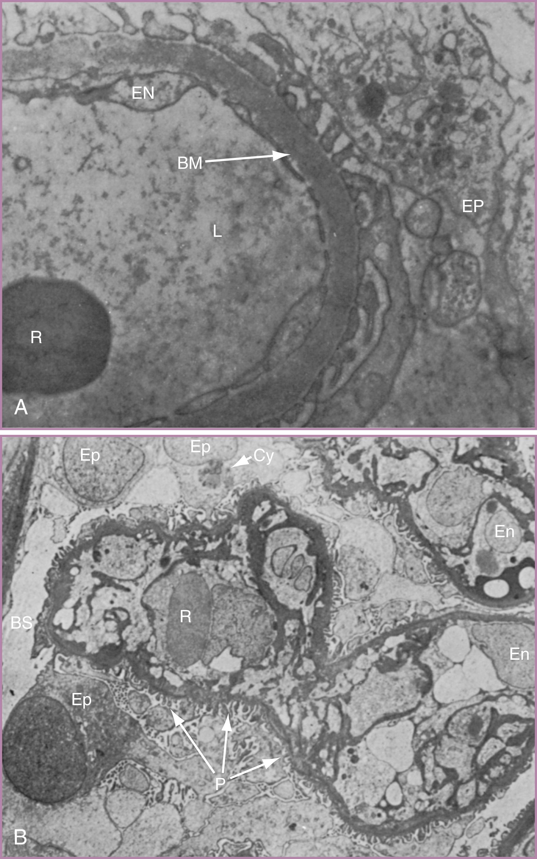 Figure 45.7, Electron photomicrographs of renal glomeruli.