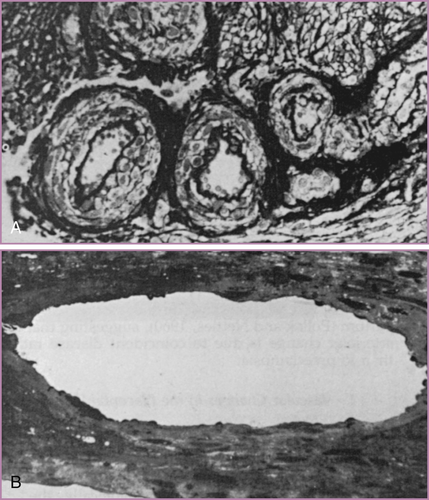 Figure 45.9, Spiral arterial changes in normal pregnancy.