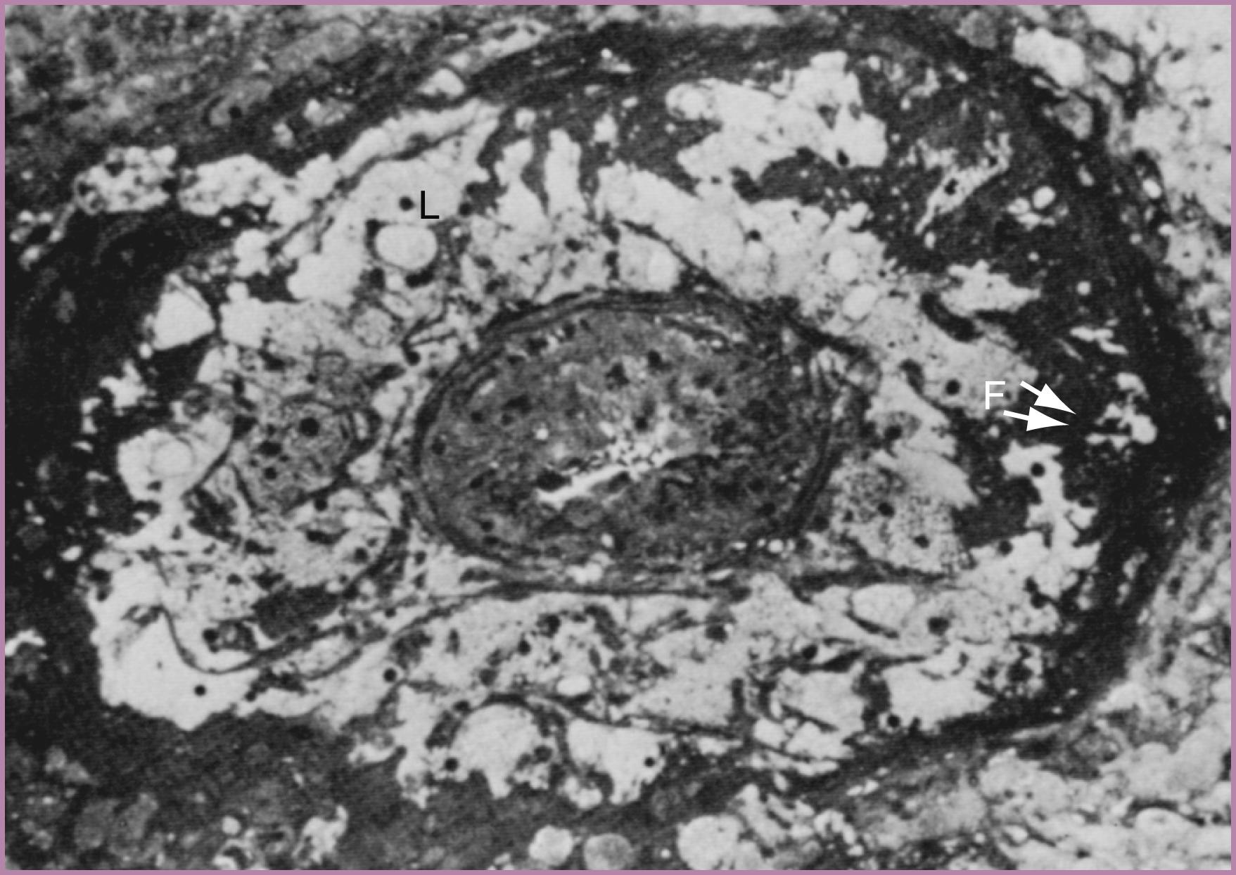 Figure 45.10, Atherosis.