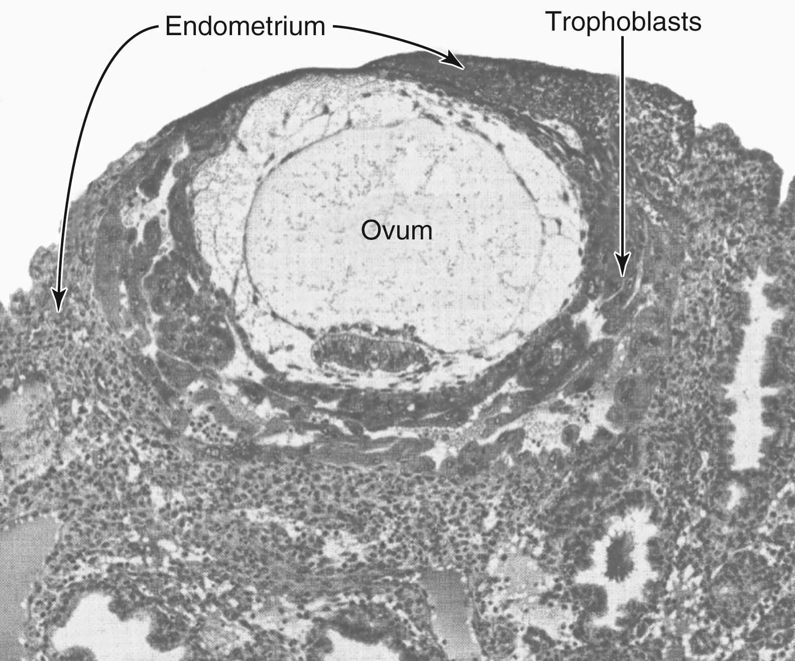 Figure 83-3., Implantation of the early human embryo, showing trophoblastic digestion and invasion of the endometrium.