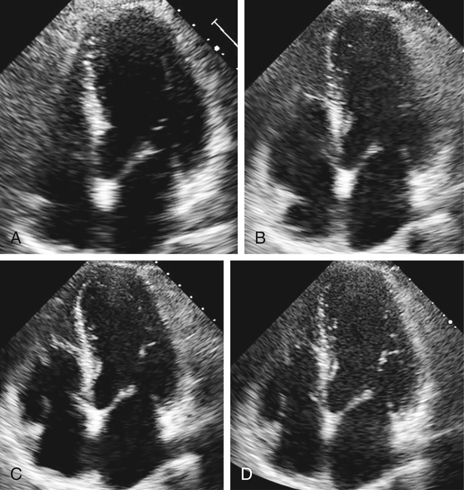 Figure 161.1, Cardiac dimension changes during normal pregnancy (first to third trimesters). Changes in cardiac dimensions during pregnancy are shown in the apical four-chamber view. Images obtained during the first trimester ( A ), second trimester ( B ), third trimester ( C ), and postpartum ( D ) are shown. Note the increases in left atrial, right atrial, right ventricular, and left ventricular size, which are most noticeable in the third trimester ( C ) in this case example.