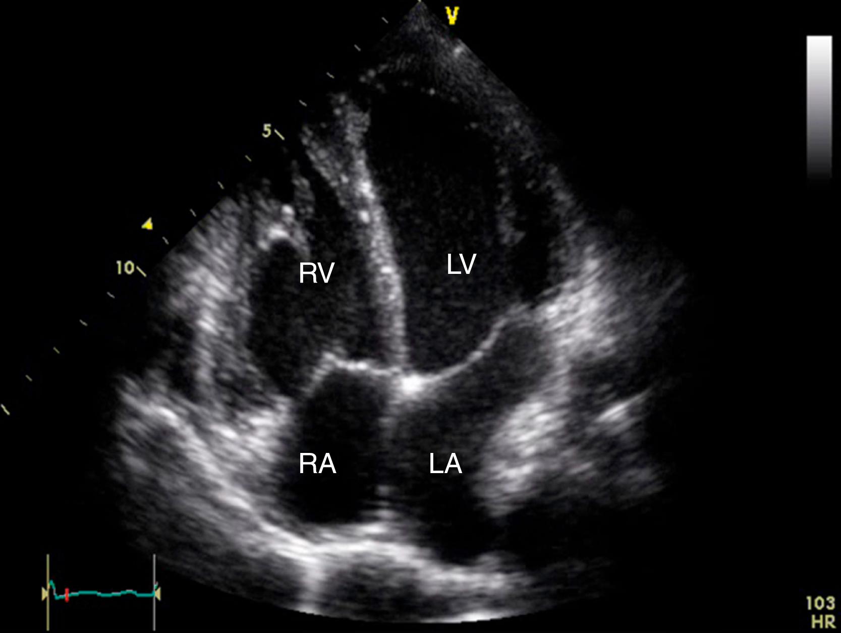 Figure 161.2, Physiologic dilatation of the right heart chambers during pregnancy. Apical four-chamber view shows physiologic right atrial (RA) and right ventricular (RV) dilatation with normal systolic function in the third trimester of pregnancy. LA, Left atrium; LV, left ventricle. (See accompanying Video 161.2 .)