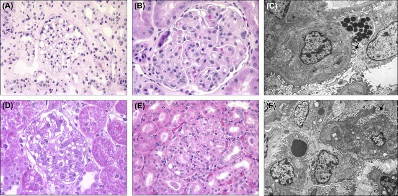 Figure 18.1, Glomerular endotheliosis. (A) Normal human glomerulus, H & E. (B) Human preeclamptic glomerulus, H & E: 33-year-old woman with twin gestation and severe preeclampsia at 26 weeks of gestation with urine protein/creatinine ratio of 26 at the time of biopsy. (C) Electron microscopy of glomerulus of the above patient described in (B). Note occlusion of capillary lumen cytoplasm and expansion of the subendothelial space with some electron dense material. Podocyte cytoplasms show protein resorption droplets and relatively intact foot processes. Original magnification 1500×. (D) Control rat glomerulus, H & E: note normal cellularity and open capillary loops. (E) sFlt-1-treated rat, H & E: note occlusion of capillary loops by swollen cytoplasm with minimal increase in cellularity. (F) Electron microscopy of sFlt-1-treated rat: note occlusion of capillary loops by swollen cytoplasm with relative preservation of podocyte foot processes. Original magnification 2500×. All light micrographs taken at identical original magnification of 40×.