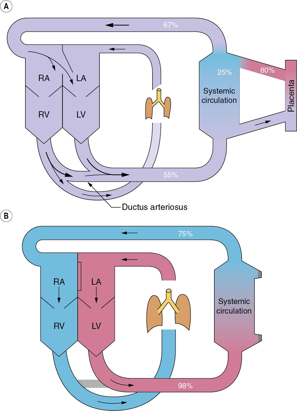 • Fig. 12.1, Fetal circulation (A) compared with adult circulation (B) . The foramen ovale is between the right atrium ( RA ) and left atrium ( LA ). LV , Left ventricle; RV , right ventricle.