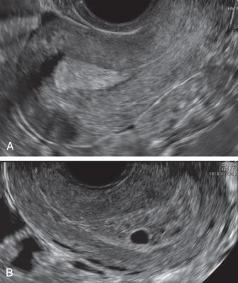 Fig. 44.1, (A) An anteverted uterus with a thick and echogenic endometrium in the late secretory phase (day 28) of the cycle is seen. (B) A retroverted uterus with a thick and echogenic endometrium in a patient with an early pregnancy; a chorionic sac is seen.