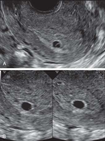 Fig. 44.2, (A) Clear chorionic sac surrounded by the bright echogenic decidual reaction is seen. (B) A magnified view of (A) demonstrates the chorionic sac; the embryonic structures (yolk sac and embryo) are not clearly imaged.