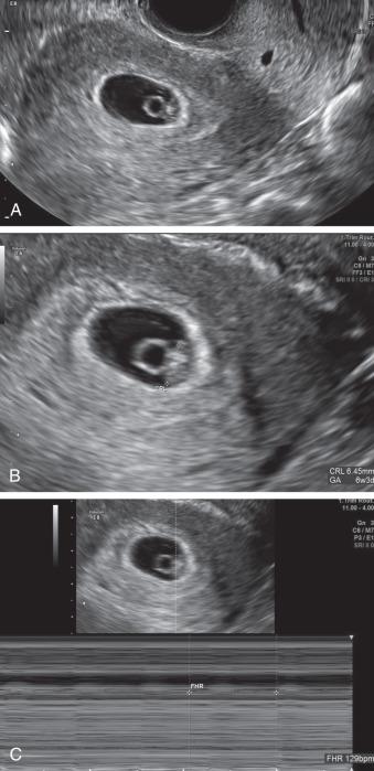 Fig. 44.3, An intrauterine pregnancy at 6 weeks 2 days is imaged. (A) The yolk sac is seen as a round echogenic ring and the embryonic pole is clearly seen in close proximity to the yolk sac. (B) The embryonic size is measured. (C) Using M-mode fetal heart of 129 bpm is imaged.