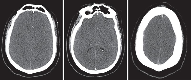 Figure 63.1, Brain CT scan demonstrating hypoxic brain injury; often such patients are labeled with a diagnosis of “traumatic brain injury,” but there is minimal contusion; a more correct diagnosis is hypoxic brain injury secondary to trauma-induced apnea.