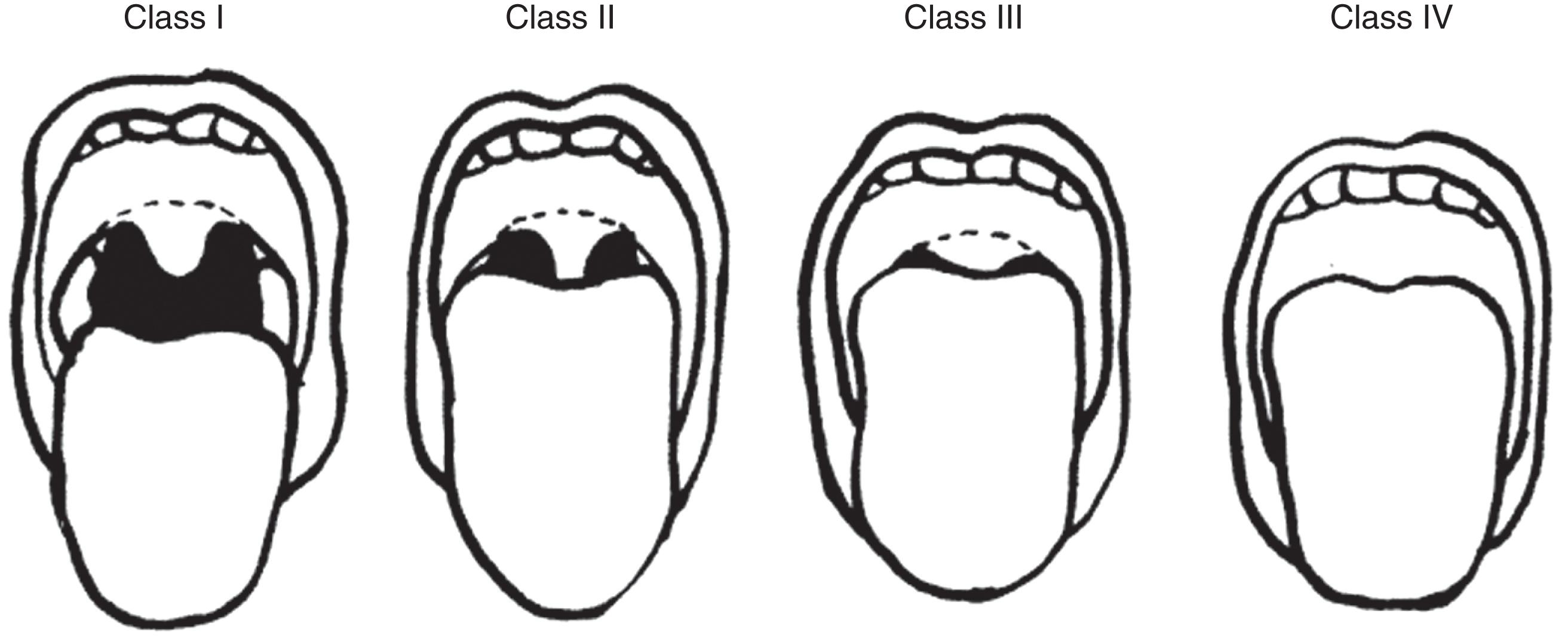 FIGURE 1, Difficult airway—the Mallampati score modified by Samsoon and Young.