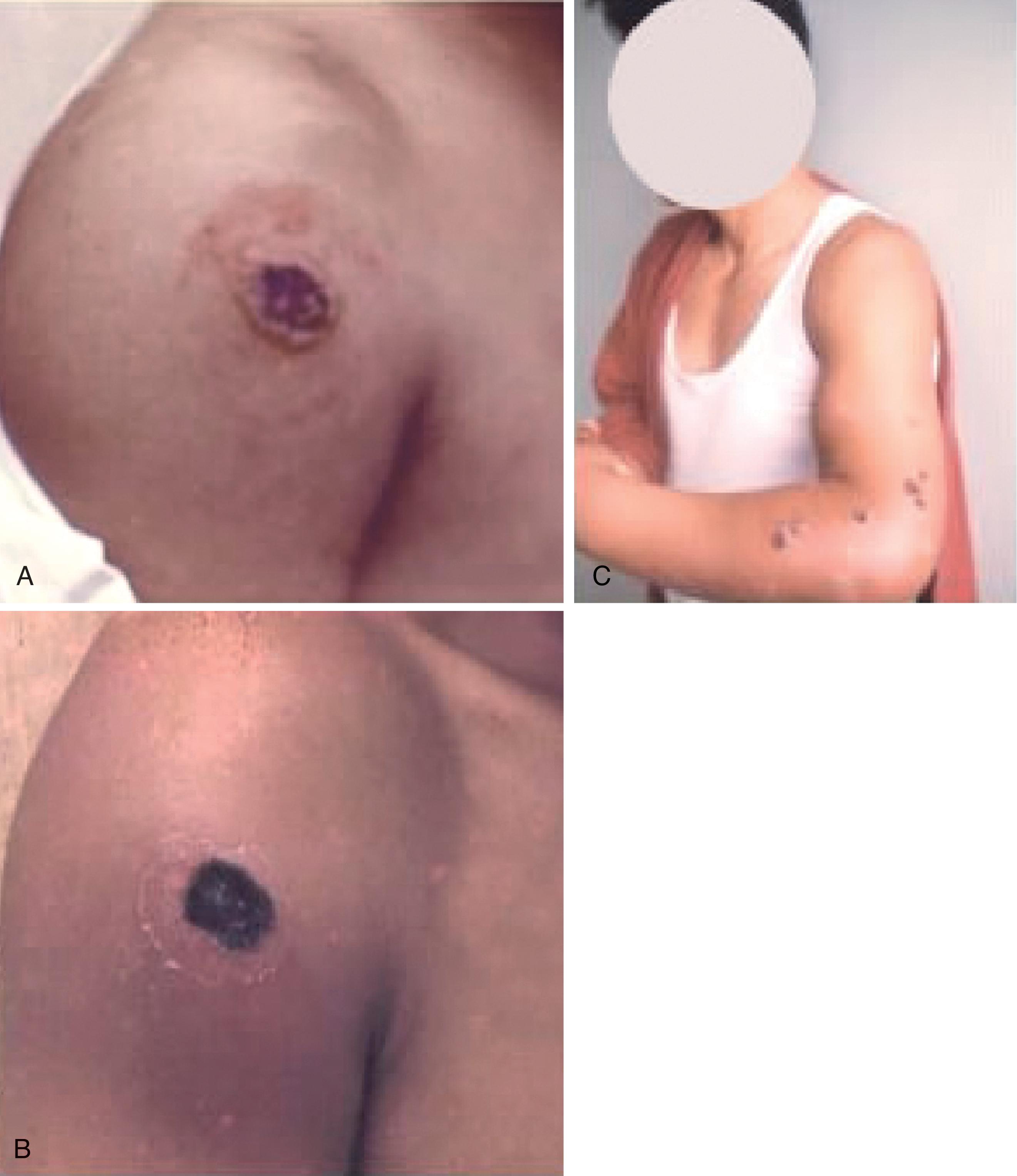 FIGURE 1, Cutaneous lesions of anthrax. (A) Ulcer with vesicle ring. (B) Black eschar with surrounding erythema. (C) Marked edema of extremity secondary to anthrax edema toxin with multiple black eschars.