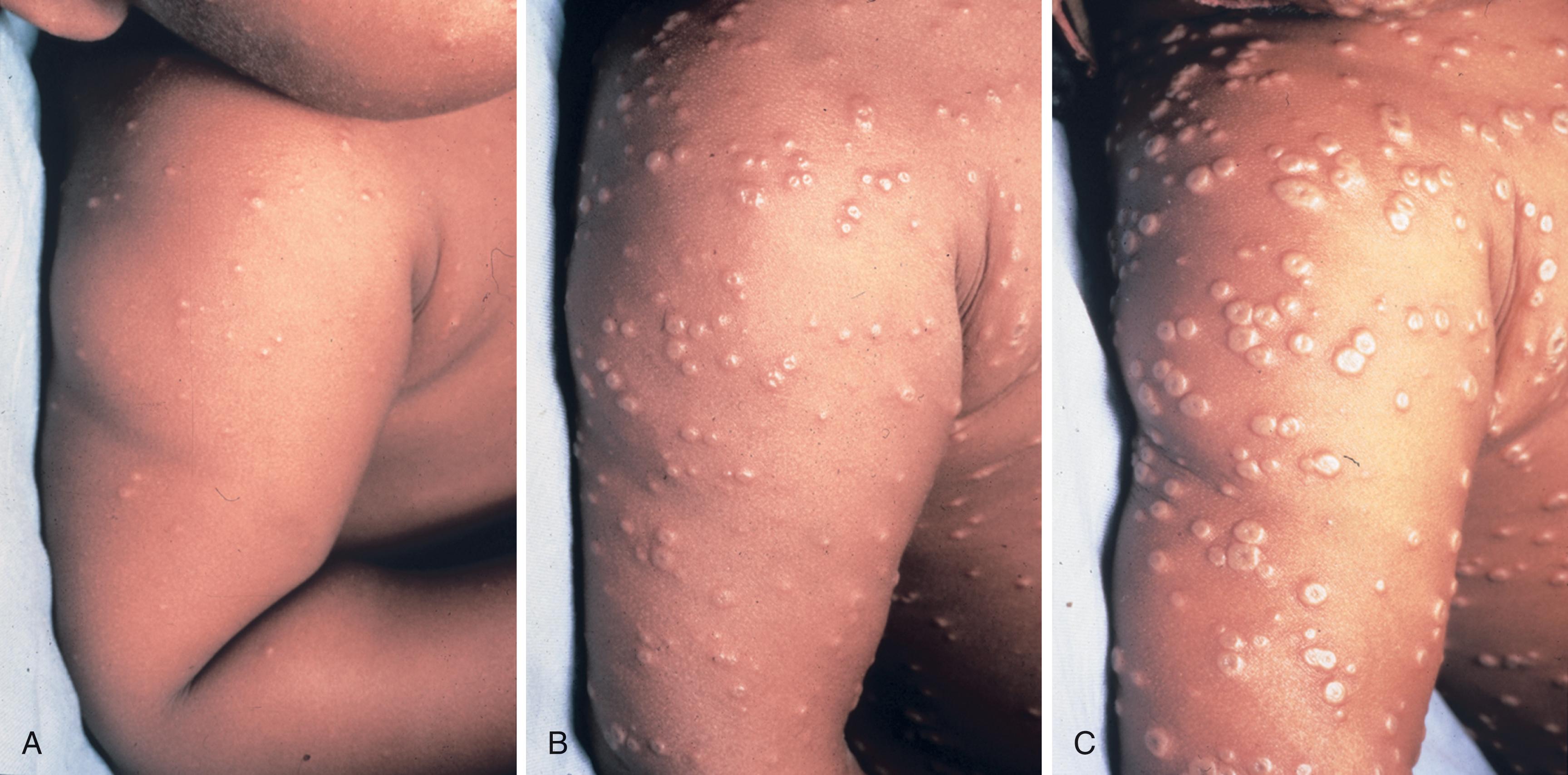 FIGURE 3, Evolution of skin lesions in an unvaccinated infant with the classic form of variola major. (A) The third day of rash shows synchronous eruption of skin lesions; some are becoming vesiculated. (B) On the fifth day of rash, almost all papules are vesicular or pustular. (C) On the seventh day of rash, many lesions are umbilicated, and all lesions are in the same general stage of development.