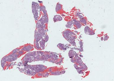 Fig. 17.3, Macroscopic view of endometrial fragment configuration of a specimen obtained by the Pipelle device.