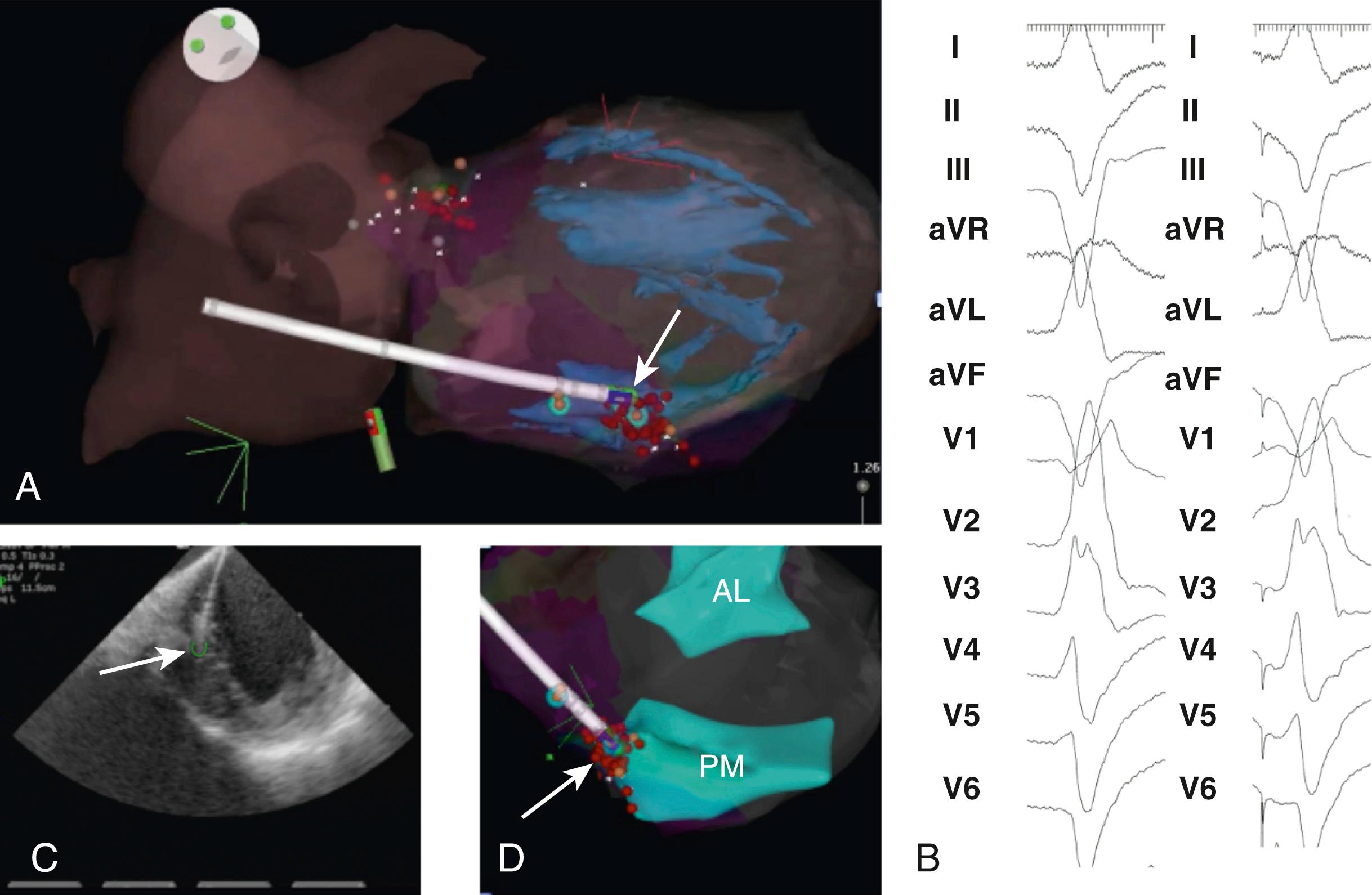 Fig. 80.2, Imaging and catheter locations in a patient with bileaflet mitral valve prolapse with recurrent VF.