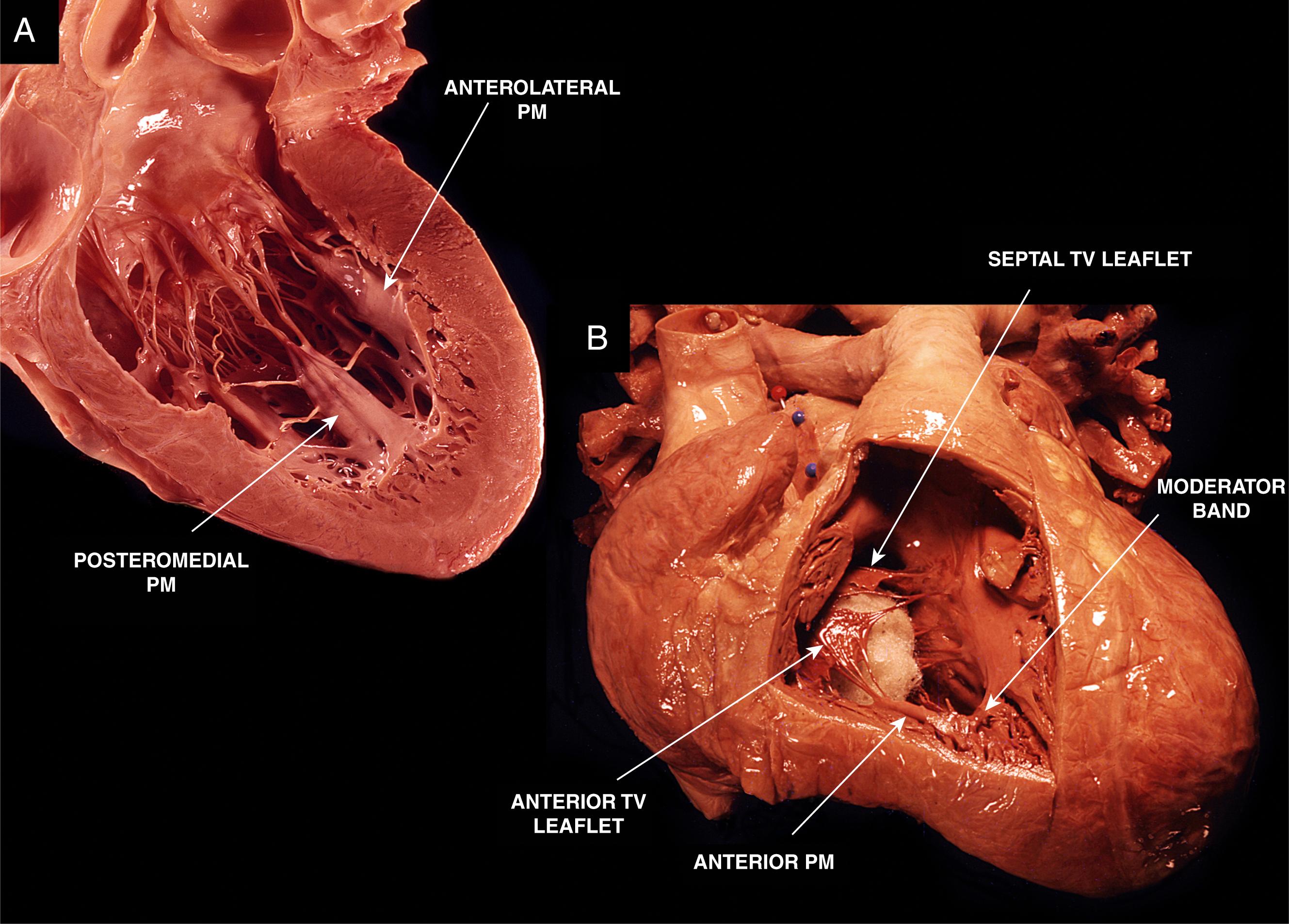 Fig. 82.1, Anatomy of left ventricular papillary muscles (A) and the right ventricular moderator band (B). PM, Papillary muscle; TV, tricuspid valve.