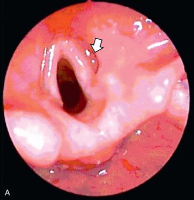 Figure 14.3, Upper airway infantile hemangiomas.