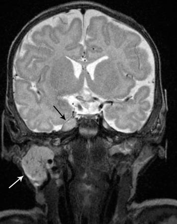 e-Figure 14.4, Multifocal infantile hemangiomas with intracranial lesions.