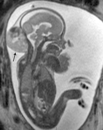 e-Figure 14.5, Congenital hemangioma.