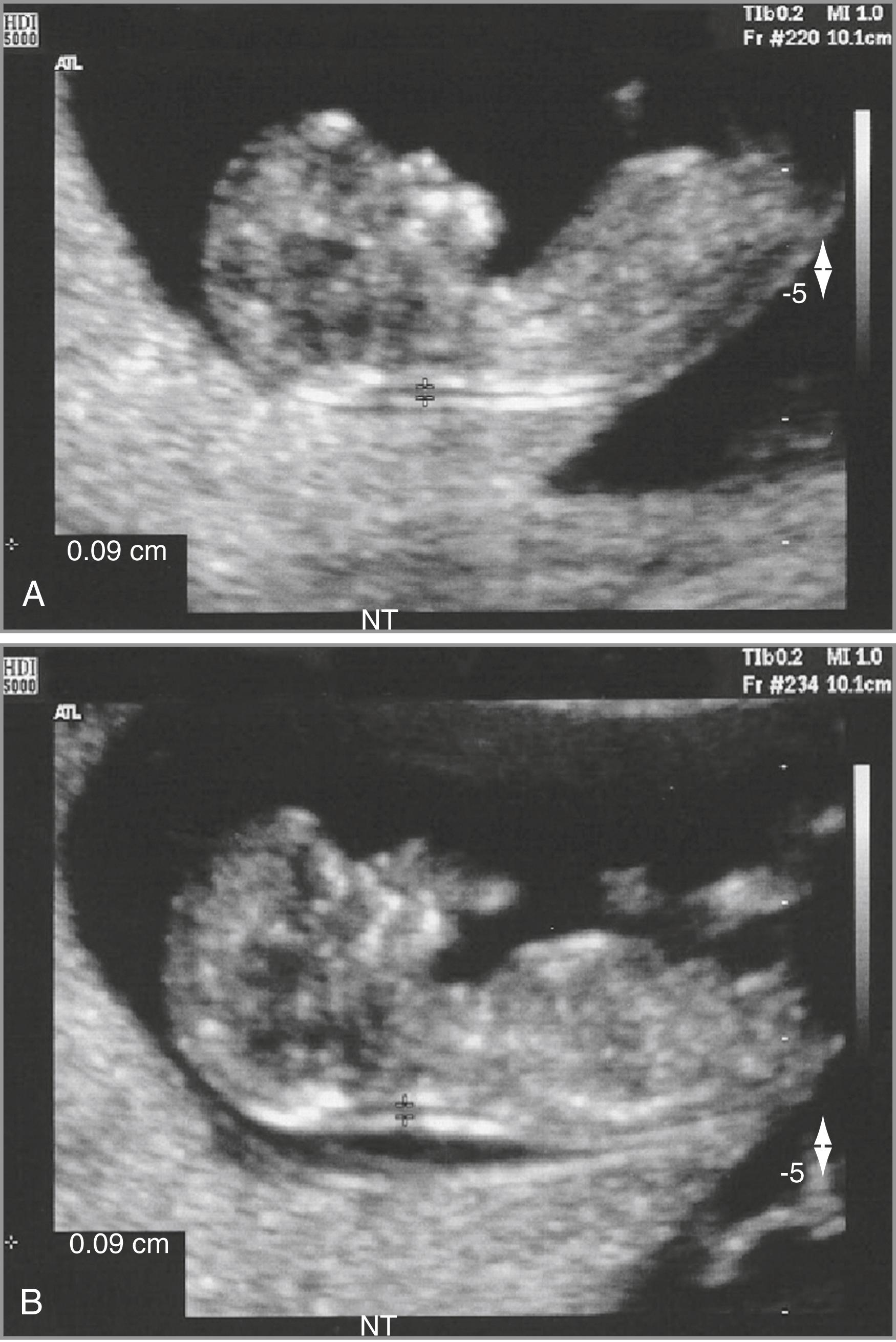 Figure 30.3, First-trimester nuchal translucency (NT) measurement.