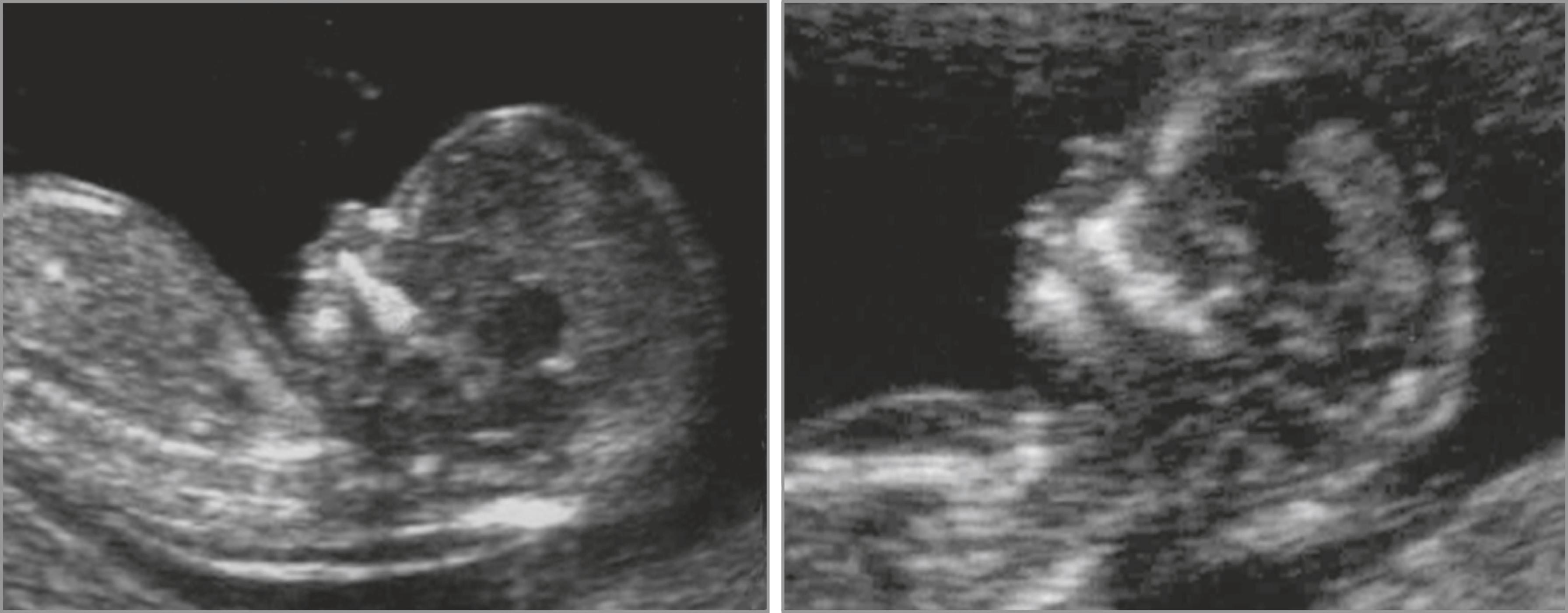 Figure 30.5, Ultrasound images of the fetal nasal bone (NB) in the first trimester.