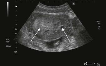 FIGURE 6-2, Placentitis in a fetus with CMV infection which appears as a thick and heterogeneous placenta with both hyper- and hypo-echoic areas (arrows).