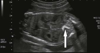 FIGURE 6-3, Coronal view of the fetal abdomen showing murally located echogenic bowel as bright as bone (EBABAB) (arrow).