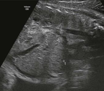 FIGURE 6-4, A parasagittal view of the abdomen demonstrating fetal hepatomegaly (between calipers).