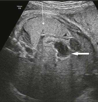 FIGURE 6-5, The enlarged slightly echogenic spleen (thin arrow) has produced subtle shift of the stomach towards the midline (block arrow).