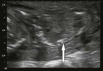 FIGURE 6-6, Meconium peritonitis actually outlining the peritoneal surface of the liver (arrow). Also note the anhydramnios (crowding of fetal parts).