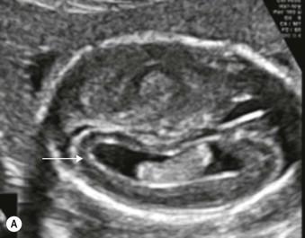 FIGURE 6-7, (A) Axial and (B) coronal scans of a fetus with intra-cranial CMV demonstrating the very typical echogenic rim to the ventricular system (arrows).