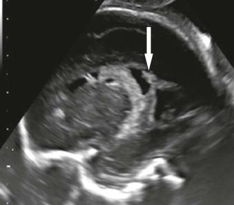 FIGURE 6-8, This parasagittal view of the fetal brain demonstrates hyperechogenicity and pseudocysts of the germinal matrix (arrow).